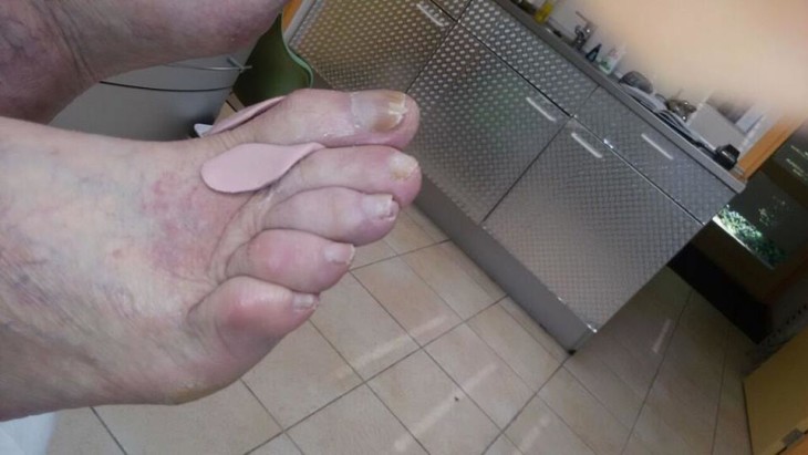 hallux rigidus orthese