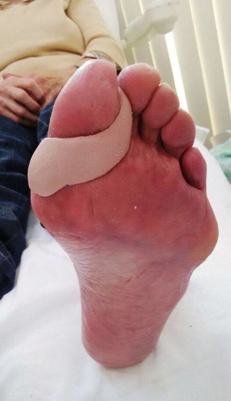 hallux valgus with protection bunion