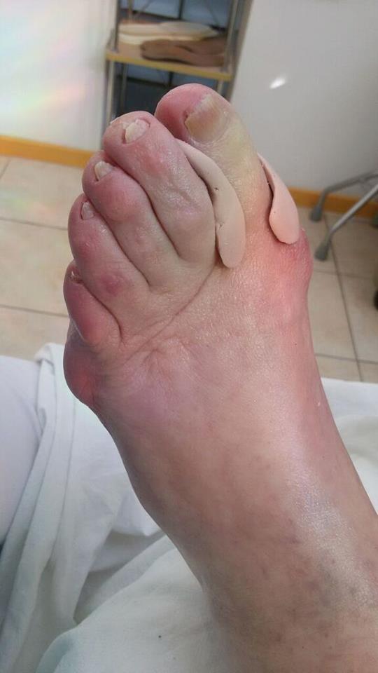 Hallux valgus orthese